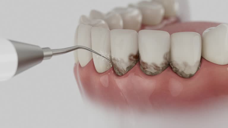 Trusted Wisdom Tooth Removal service in The Villages, FL - Dentist Open Now